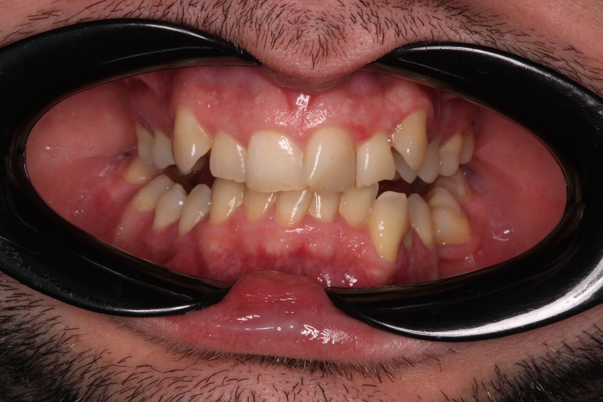 Скученность зубов: почему домашняя чистка часто неэффективна